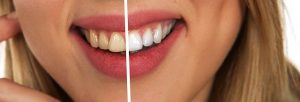 5 טיפים שיסייעו לכם לשמור על שיניים לבנות