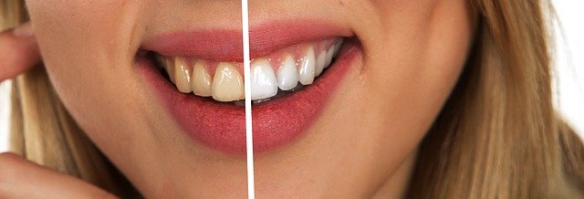 Read more about the article 5  טיפים שיסייעו לכם לשמור על שיניים לבנות